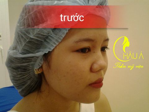 Khách hàng trước khi nâng mũi