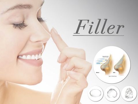 Nâng mũi bằng filler