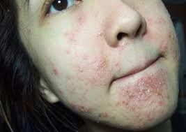 trị mụn nên uống thuốc gì