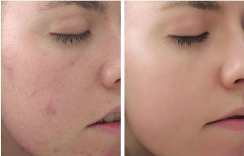 Điều trị mụn mủ