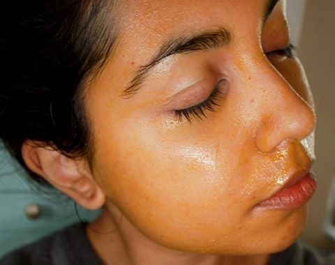 Cách trị mụn thâm hiệu quả nhất