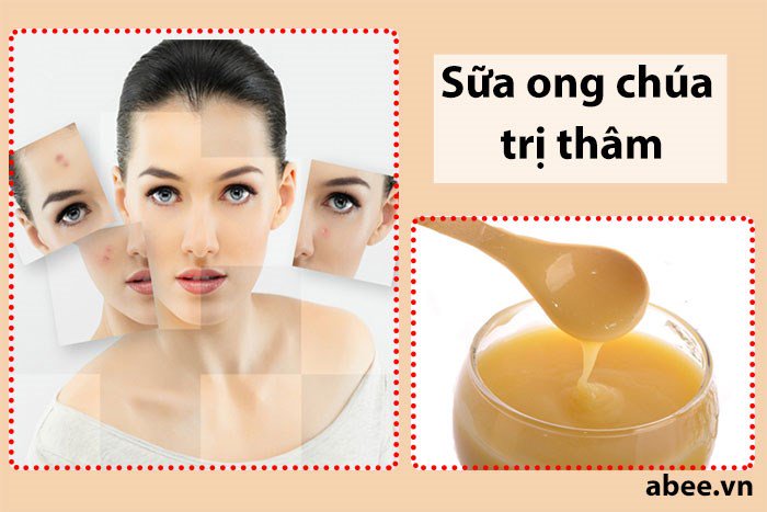 http://abee.vn/blogs/sua-ong-chua-tuoi-nguyen-chat/huong-dan-cach-chua-tri-vet-tham-nam-hieu-qua-bang-sua-ong-chua