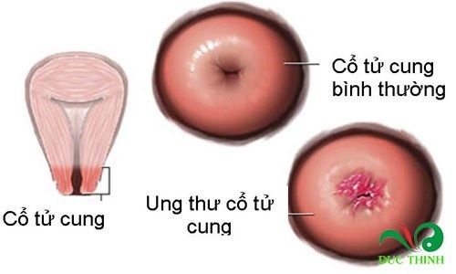chua tri ung thu bang cay xa den 1