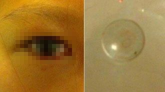 Đeo kính áp tròng suốt 2 năm, 1 cô bé đã khóc ra máu