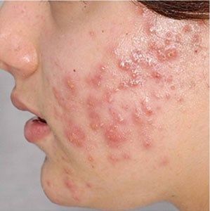 Điều trị mụn mủ