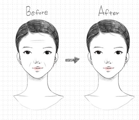 wrinkle-lift-mx-02