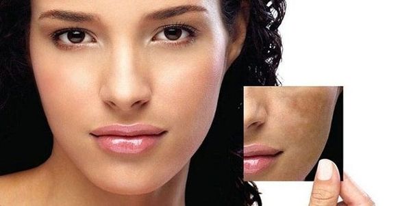 Trị Nám Hiệu Quả