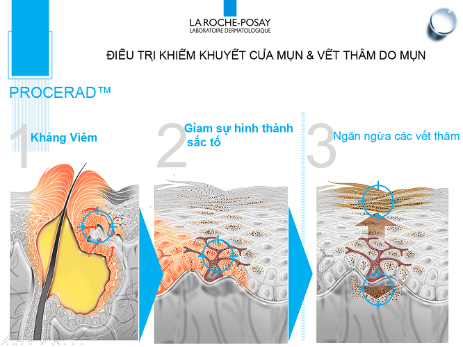 kem tri mun la roche posay effaclar duo plus giup lam giam mun