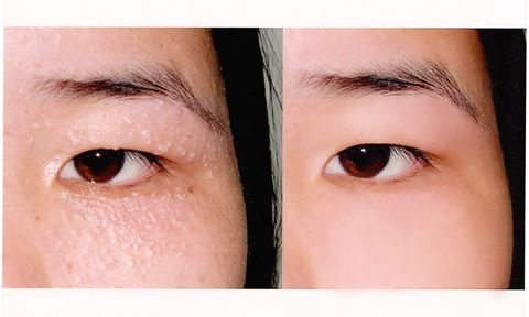 kết quả điều trị mụn thịt
