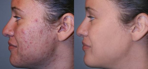 Cách trị mụn hiệu quả Huyền Cò