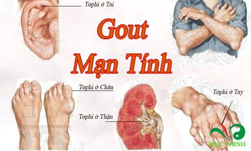 cao gam tri gout 1