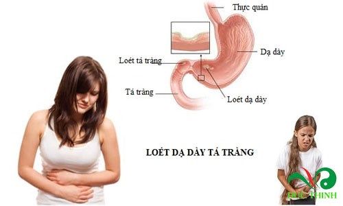 tra day chua tri dau da day