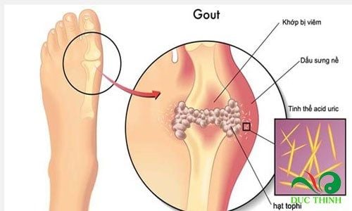 cao gam tri benh gout