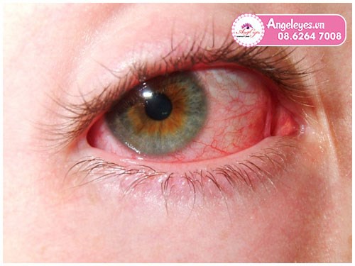 Cách sử dụng kính áp tròng giúp tránh các bệnh viêm mắt-02