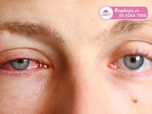 Cách sử dụng kính áp tròng giúp tránh các bệnh viêm mắt-03