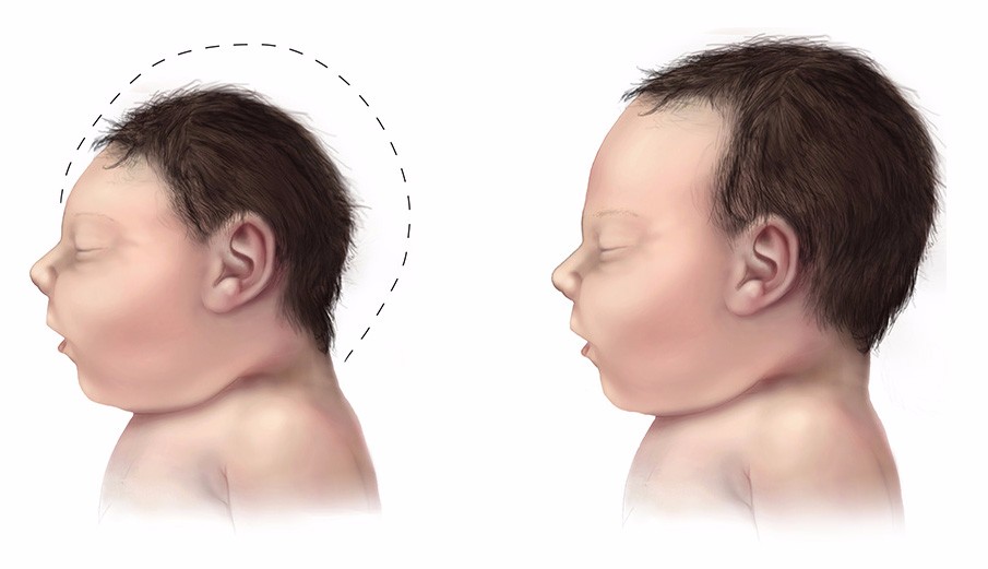 Cảnh báo nguy cơ nhiễm virus Zika tại Đông Nam Á